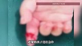 妈妈拆快递剪刀误伤女儿，7个月大宝宝手指被剪断，手术后顺利出院