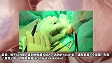 男子头长“魔鬼角”一碰到疼