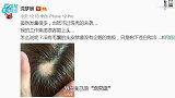 沈梦辰因过度焦虑斑秃，脑袋顶部露出一大块头皮，自嘲没有主持