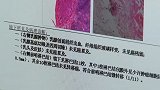 广东佛山：六旬老伯胸部摸到硬物，一查竟是患上了乳腺癌