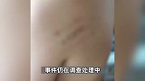 河北一家长称孩子屁股被打成黑紫色，宣传部：涉事教师已停课