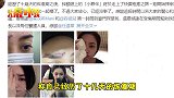 心疼！阿娇额头高清伤口首曝光，针孔清晰可见缝了十几针