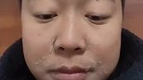 男子高烧40度两天，脸上起干皮
