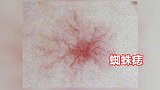 广东惠州：35岁男子皮肤出现“蜘蛛痣” 发现时已肝癌晚期