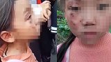 宜宾妇联回应女孩满脸伤痕：系其爷爷女友所为