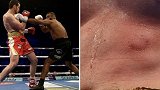 拳台再现严重咬人事件 15战全胜拳手将对手咬出牙印