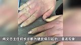 女子长期手麻、手指发白跑3个科室没发现问题，竟靠DeepSeek找对医生！这病极易误诊