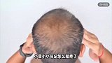 爷爷爸爸都没秃，16岁男孩每天睡5小时先秃了！医生：精神压力大、睡眠不足
