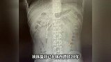 12岁误吞体温计32岁时取出！男子腹痛就医险些引发大出血，医生紧急提醒