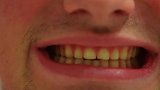 小伙的牙齿只有常人三分之一大，从未啃过苹果