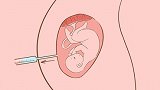 医羽试管：在试管移植后需要保胎吗？