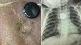 英国一妈妈在儿子误吞电池后用培根模拟食道被灼伤画面