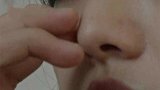 陕西西安：17岁少女流了十年脓鼻涕，只因鼻子里长“石头”