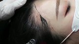 女子嫌发际线高不好看，做了永久纹发际线，颜值提升了不少
