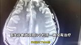 24岁小伙因3颗烂牙拖2年未治，致病菌感染大脑，被切除部分头骨