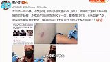 蔡少芬回应录制节目中前往医院：被狗狗咬了一口