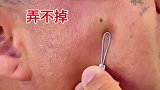脸上有个刺，居然弄不掉