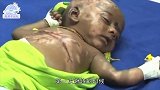 印度男婴成“自燃人”3个月自燃4次，皮肤烧焦还能活