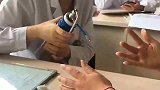 用液氮冷冻法治疗，感觉手指不是自己的，已经变形！
