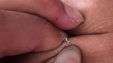腿上挤出白虫子，要不要找大夫