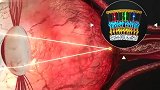 你知道近视是如何产生的吗？做近视校正手术有用吗？看完你就懂了