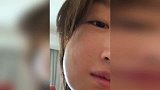 周冬雨拔完智齿后晒照 撞脸被蜜蜂蛰了的狗狗心疼又搞笑