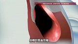 浙江17岁男子鼻塞3年，颅底竟藏着80克重的血管瘤，医生提醒