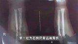 男婴在月子中心被照料20天：身上2处骨折脑电图异常，警方正修复监控