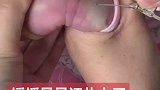 这是个新生宝宝的手臂，留置针是软的