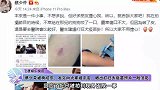 蔡少芬被狗咬伤，发文向大家报平安，晒出打狂犬疫苗照片一脸淡定