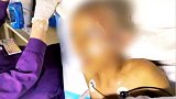 广东东莞：被妈妈用农药焗头驱虱，11岁女孩进了ICU险丧命