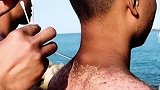 训场上，战士们皮肤被灼伤