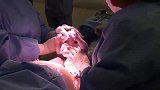产妇剖腹产生双胞胎宝宝全过程，向伟大的母爱致敬！