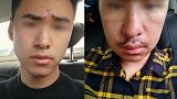 西安小伙隆鼻后鼻子歪斜呼吸困难：感觉老了十几岁