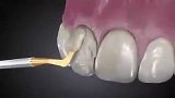 3D动画演示补牙修牙的过程,操作过程还挺复杂的