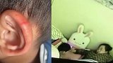 浙江一幼师用剪刀划伤男童耳朵 园方：涉事老师已开除