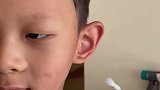 7岁男孩被蚊子咬成大耳朵图图