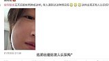 周冬雨拔智齿，五天后脸仍然肿成包子，评论区一片笑声