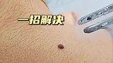 液氮冷冻治痦子，一招解决