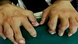 把饮料当水喝！23岁小伙患痛风10年双手长满痛风石