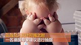 2岁女孩双手肿胀如莲藕 做抽脂手术不为变美只为健康