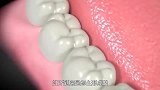蛀牙究竟是怎么形成的？