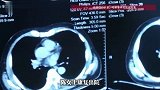 31岁女子不抽烟，作息规律，陪母体检意外查出患肺癌，医生提醒