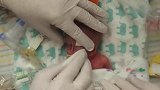 23周的早产儿，一出生就用上了特殊的呼吸机维持生命