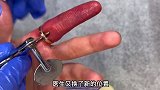 医生切除戒指，只因试戴的时候戒指过小！