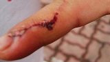 杭州男子被五步蛇咬伤后一刀斩断手指 医生：没必要