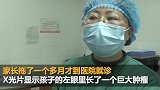 江苏8个月大宝宝长了一只“猫眼” 一查竟是肿瘤惹的祸