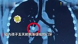 辅导作业太“上头”，妈妈一巴掌将孩子乳牙打进气管