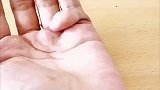 我也是6根手指，但是我这第六根手指和别人的不一样啊
