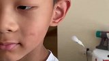 7岁男孩被蚊子咬成大耳朵图图